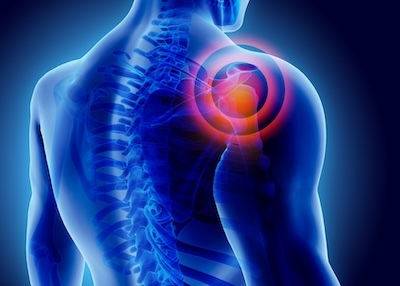 NIH-Funded Study Launches at SPRI to Advance Shoulder Repair Techniques