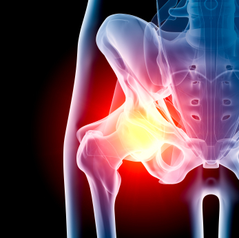  Vail, CO Hip Surgeon, Dr. Marc Philippon, Published in PubMed for his Study on the Arthroscopic Treatment for Femoroacetabular Impingement in Adolescents