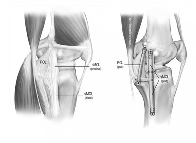  Steadman Philippon Research Institute Develops Reconstruction Technique for MCL Tears and Injuries